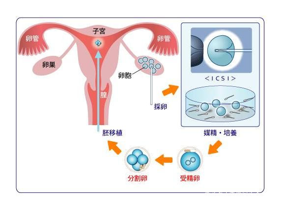 试管婴儿