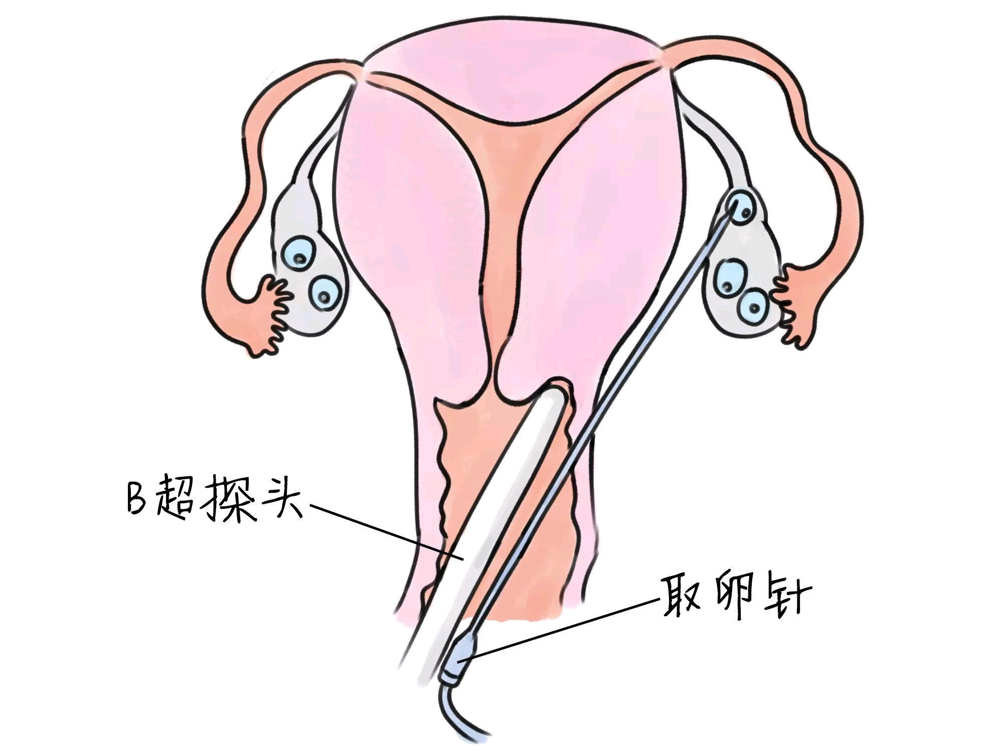 试管婴儿